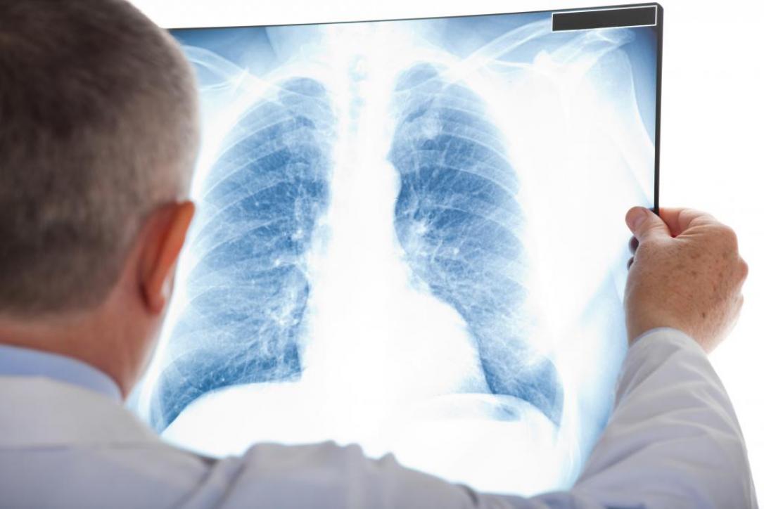 Erkeklerde kansere bağlı ölümlerde ilk sırada akciğer kanseri yer alır.